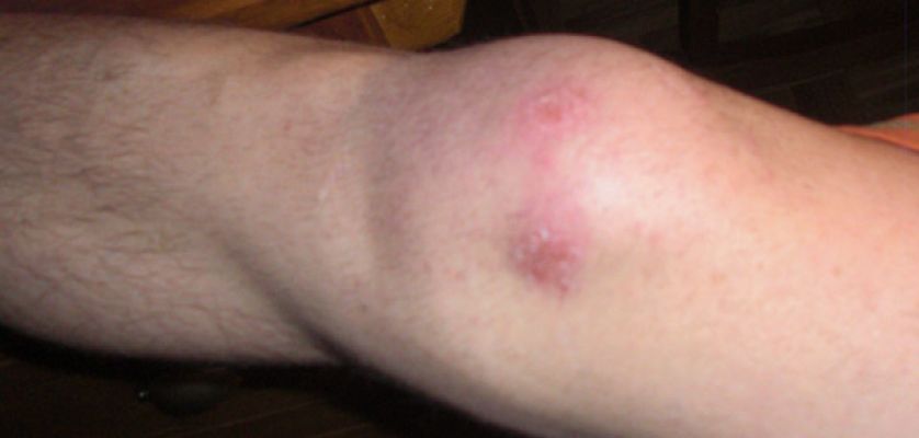 Condromalacia rotuliana, lesiones de rodilla