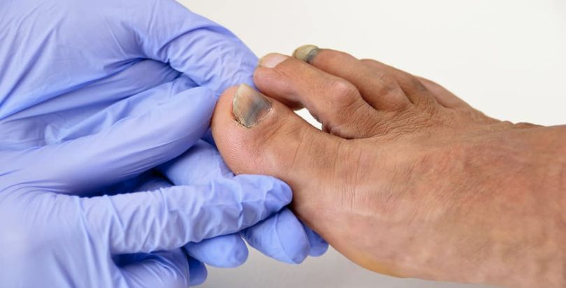 Come proteggere il piede dalle unghie nere quando si corre: il podologo