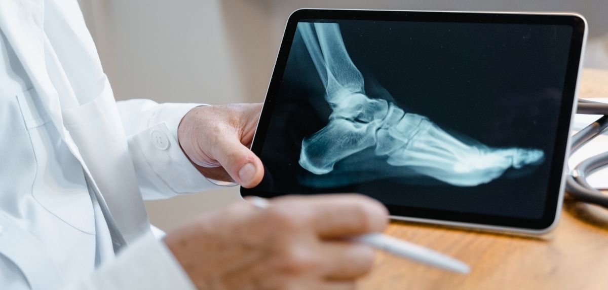 Tipos comunes de dolor en los pies en carrera - Metatarsalgia